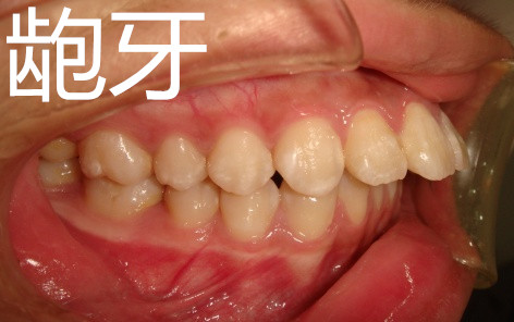 30岁还可以牙齿矫正吗,30岁牙齿矫正一般多少钱