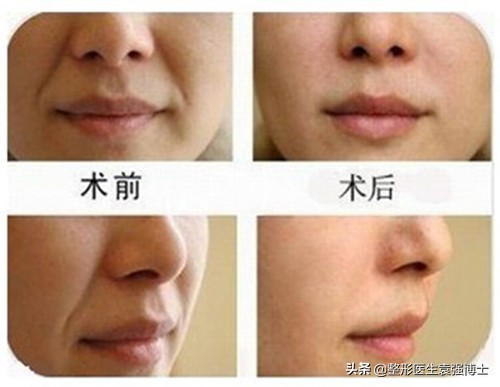 法令纹真正有效的方法,法令纹用什么方法解决比较好