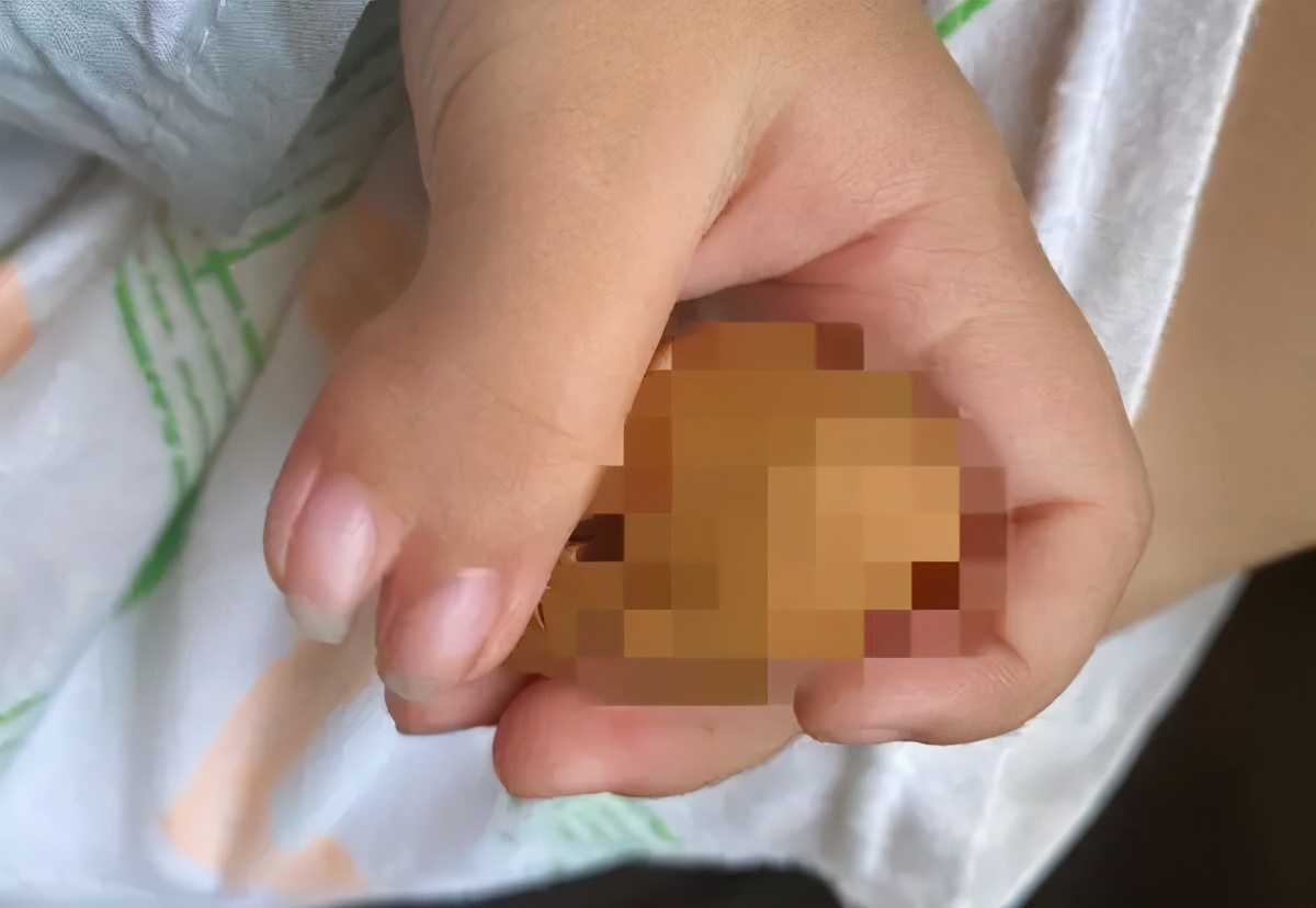 18岁女孩手指长得像螃蟹钳子！专家建议：先天性手部畸形早做矫形手术