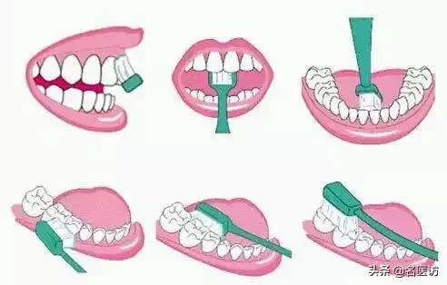 牙周炎才是牙齿松动的罪魁祸首,牙周炎导致全部牙齿脱落镶什么牙