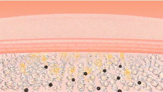 眼角皱纹最显老要注意防晒,眼角皱纹去皱最有效的方法