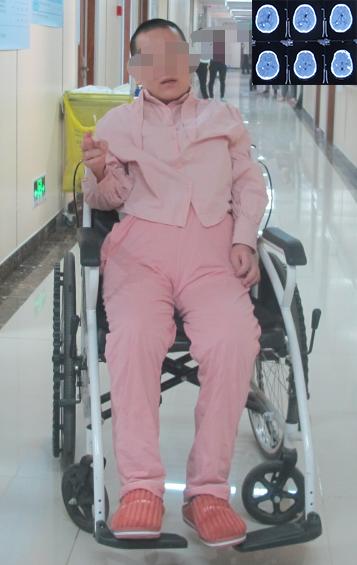 脑室有粘连脑积水有什么办法,脑动脉畸形手术后出现急性脑积水