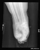 美人鱼真实存在的5件事,美人鱼婴儿畸形手术