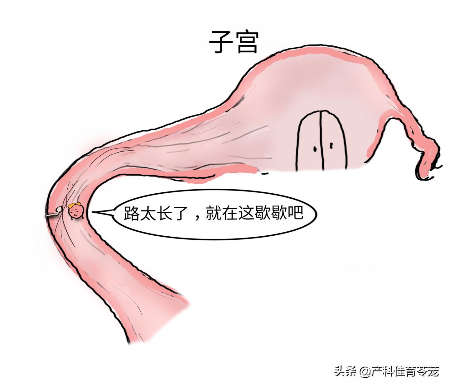跑步能预防宫外孕吗,试管怎么预防宫外孕
