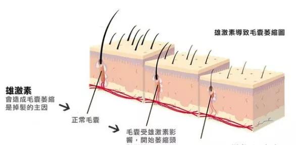 m型脱发临床诊断怎么写,m型脱发最新研究