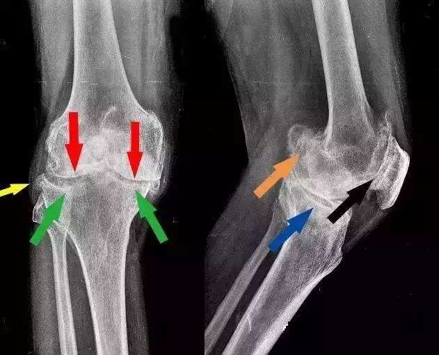 颈椎长骨刺该怎么治疗呢,颈椎骨刺有什么说法