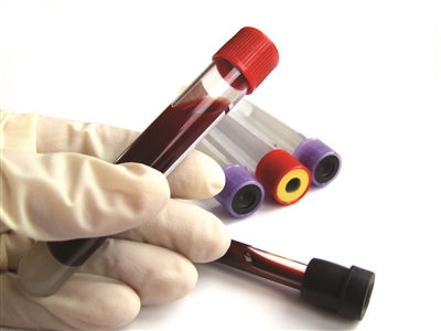 同型半胱氨酸高是老年痴呆前兆吗 (关注同型半胱氨酸预防老年痴呆)