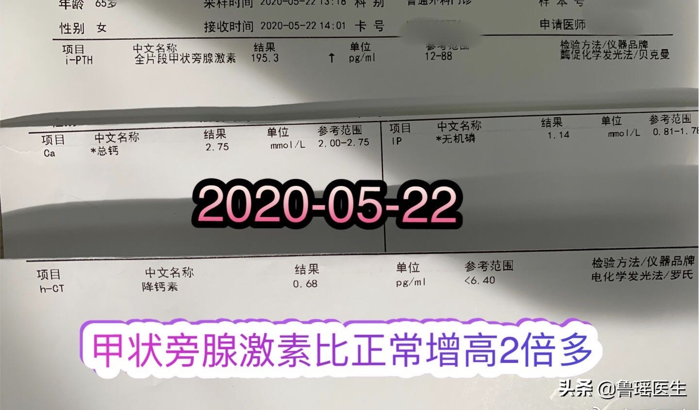 手术造成甲状旁腺损伤,牙齿增生手术全过程