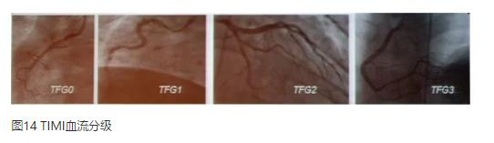 清晰完整揭秘冠脉造影全部过程,冠脉造影教学视频