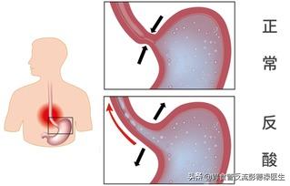 胃部不适恶心幽门螺杆菌感染,幽门螺旋杆菌引起腹部饱胀