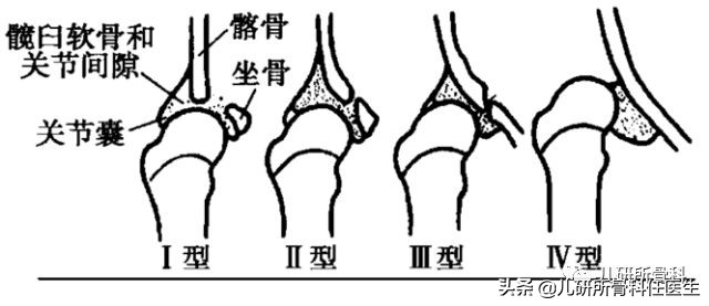 孩子臀纹不对称，看完门诊还是不明白？一次性解答你所有问题