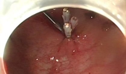 坐过山车抖落肾结石,坐过山车排出肾结石