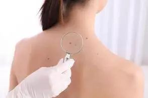 到底要不要祛痣,该不该去医院点痣