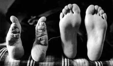 漏尿与内脏下垂,漏尿先天畸形