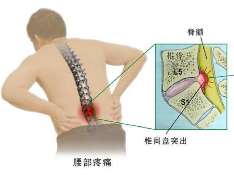 腰椎膨出和突出还有脱出图片,腰椎间盘突出脱出膨出区别
