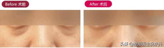 下眼皮松弛没有眼袋能外切吗,眼睛痒干能不能做切眼袋手术