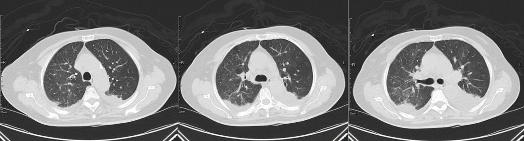 肺部阴影不是感染的代名词，这例患者差点误诊为社区获得性肺炎