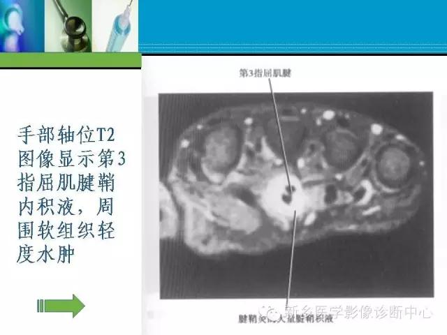 单只手指磁共振,手指用磁共振能做出来结果吗