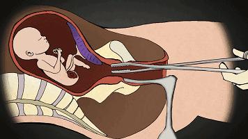 多次人工流产后再次流产危险,两年做了三次流产手术
