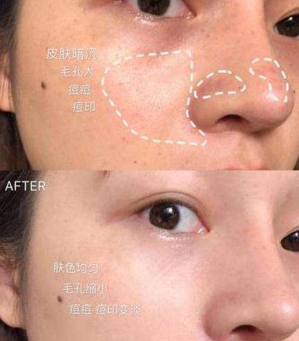 皮肤暗沉无光怎么办,补水精华液皮肤暗黄