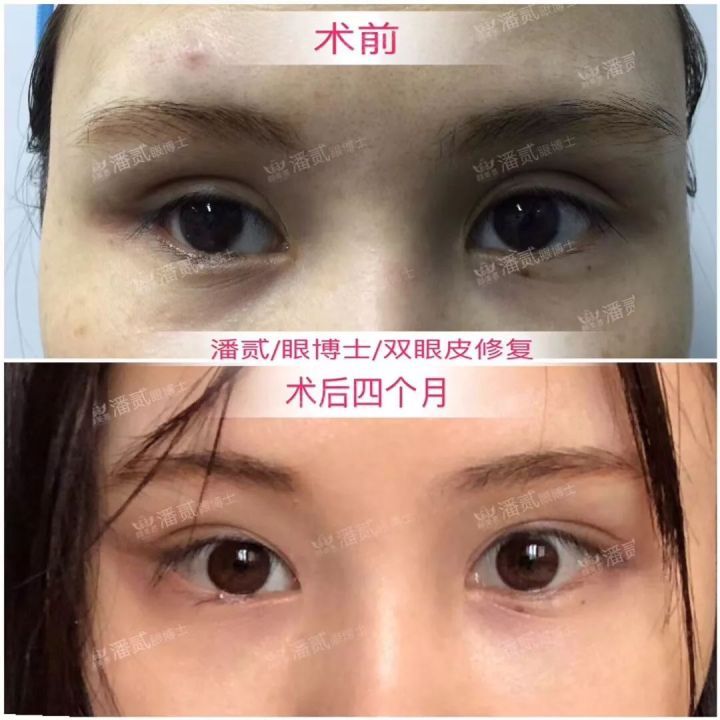 双眼皮凹陷眉毛怎么设计好看,凹眼窝适合什么眉型