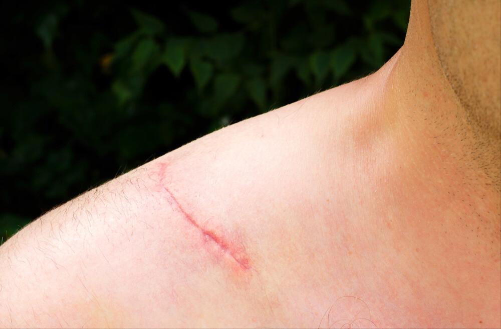 宝宝蚊子叮咬疤痕怎么去除,蚊子叮咬用手抓破后伤好后有疤痕