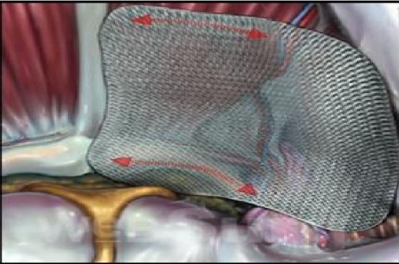 腹股沟疝怎么治,什么是腹股沟疝气啊