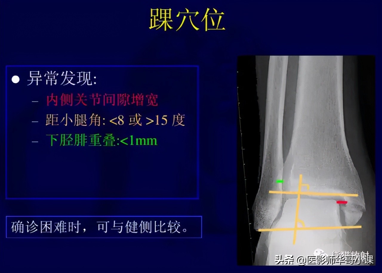 踝关节解剖视频课,解剖学韧带分布图