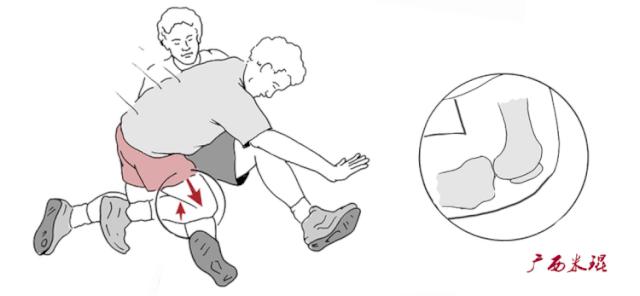 交叉韧带损伤的mr表现,后交叉韧带损伤的诊断实验