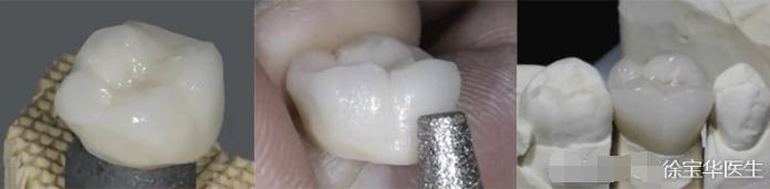 烤瓷牙贴片全口价格,贴片牙齿和烤瓷牙有哪些伤害