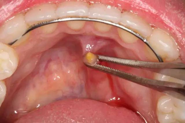 唾液腺结石长在口腔里,口腔唾液结石快速解决方法
