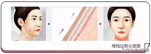 医美都有哪些项目改善皮肤,毛孔粗大的护肤和医美思路有哪些