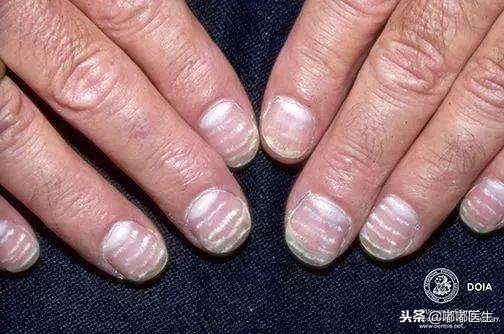 指甲有白点肚子里有蛔虫？月牙越大越健康？指甲软是缺钙……