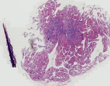 真实案例：警惕建筑材料中致病因素！患者3.9cm甲状腺结节已融合