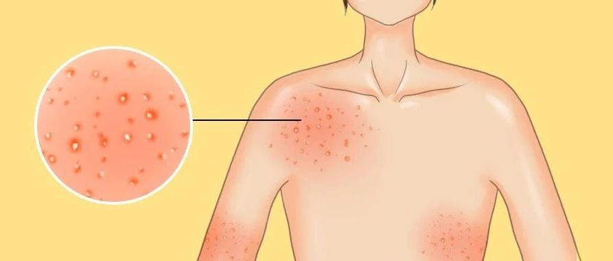 皮炎湿疹反反复复什么原因,夏季湿疹皮炎如何解决