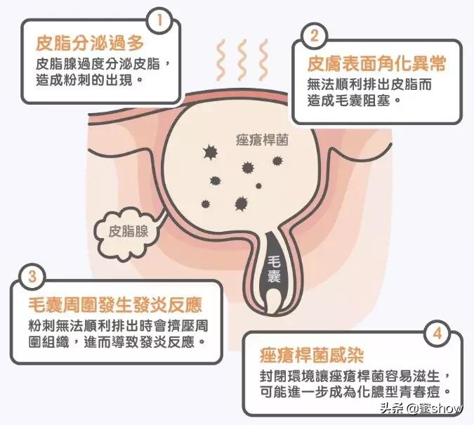 皮肤问题控油缓解长痘,解决皮肤痘痘问题