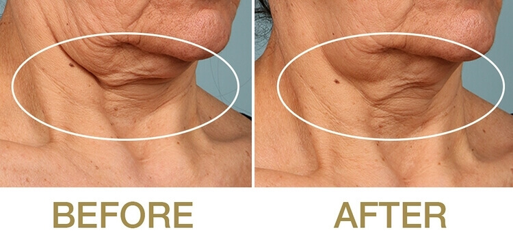 比肉毒杆菌还神奇！安全又有效，难搞的颈纹有它再也不用烦恼！