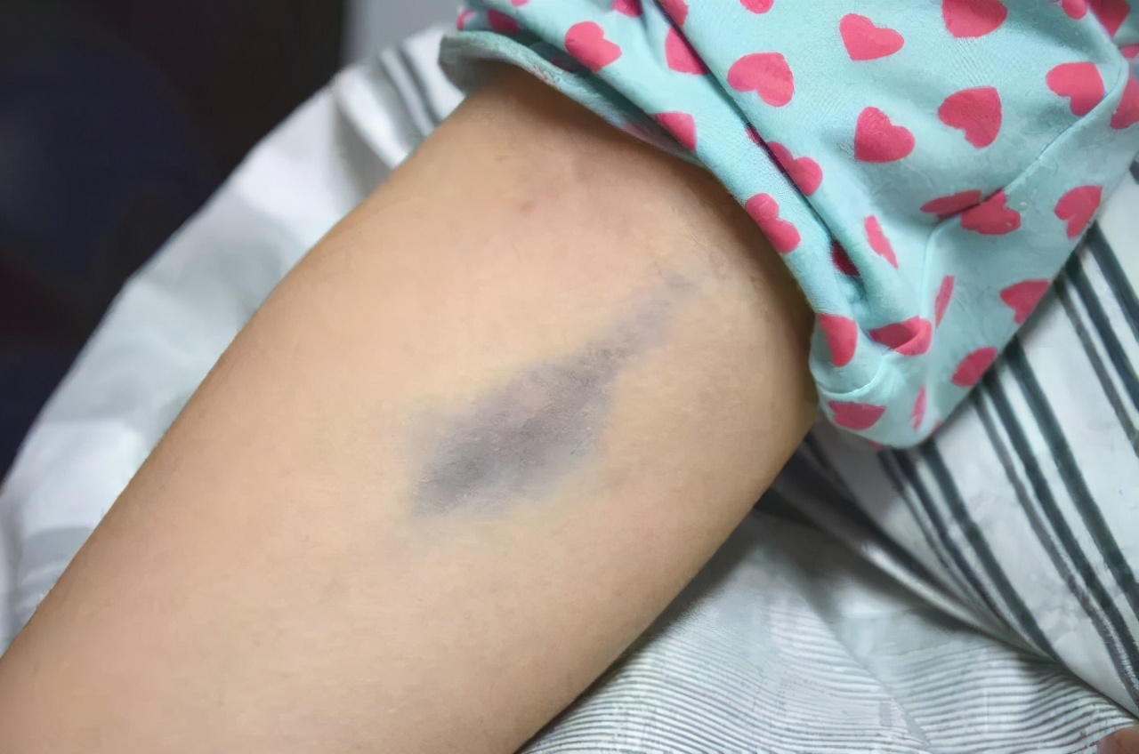 磕磕碰碰有淤血？淤血怎么治？中医分享一味活血化淤小药材