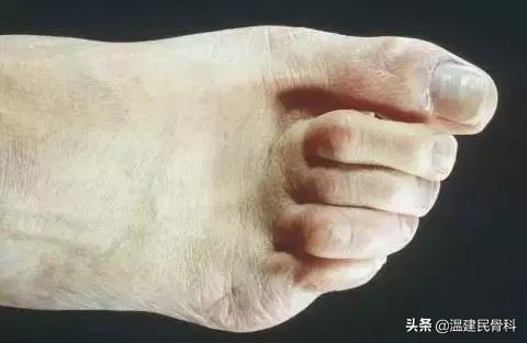 健康之路茧子,cctv10健康之路在线直播回看