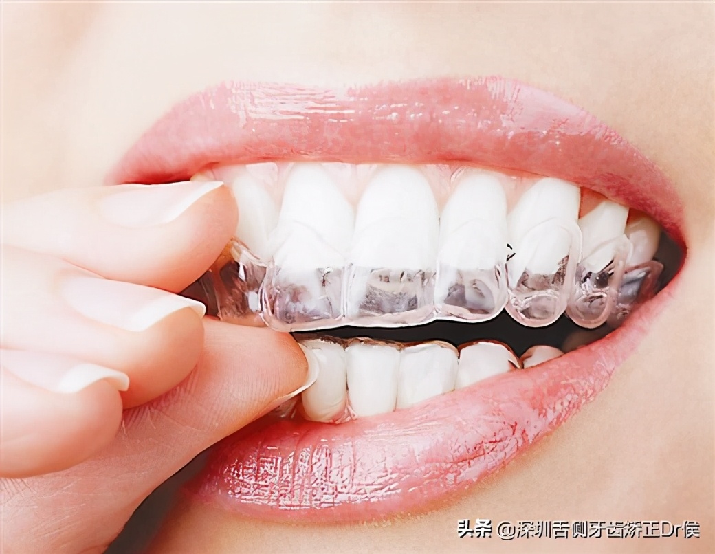 30岁以后还能牙齿矫正吗,30多岁还能牙齿矫正吗