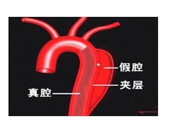 a型主动脉夹层为什么凶险,异常凶险的心脏病主动脉夹层