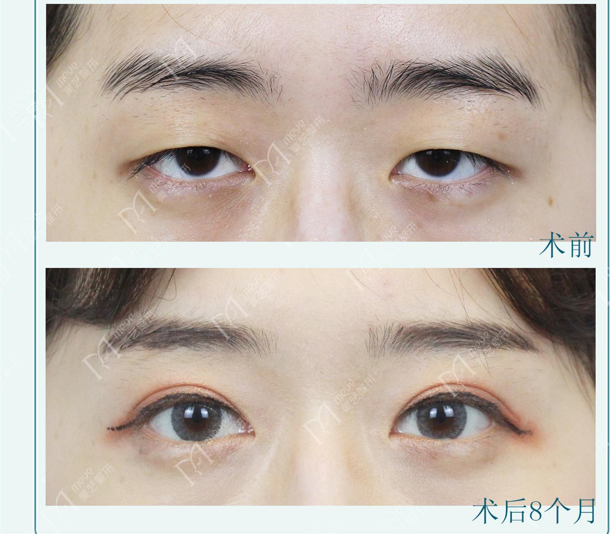 做双眼皮时判断出肌无力但未提肌,做双眼皮说是眼睛肌力不够