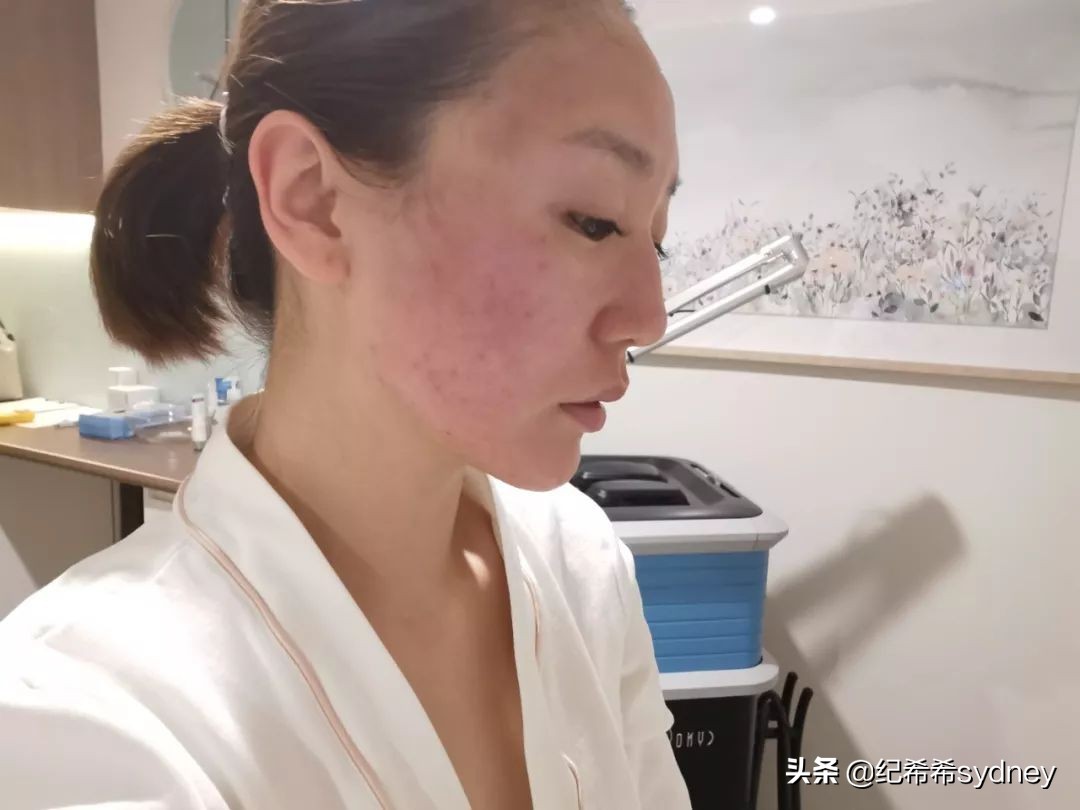 皮秒真实测评,皮秒收缩毛孔测评