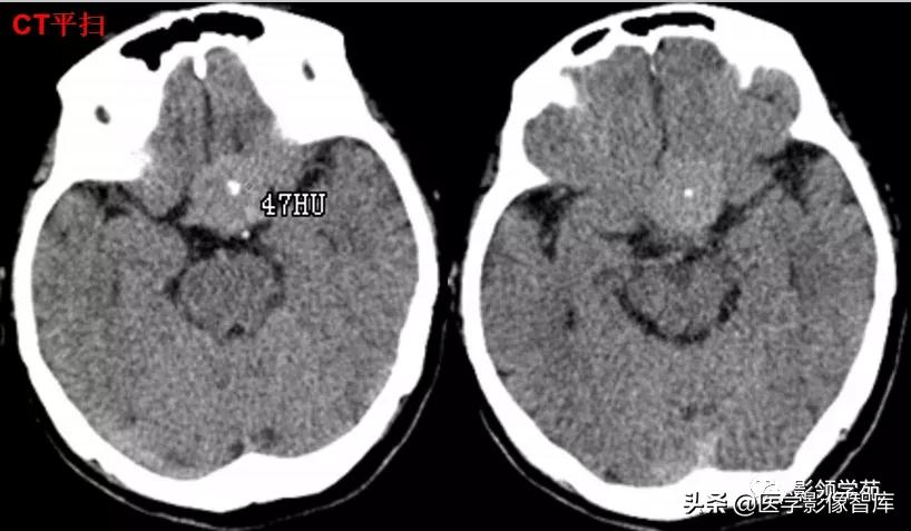 鞍区肿瘤做什么检查得出来,鞍区肿瘤的影像学鉴别