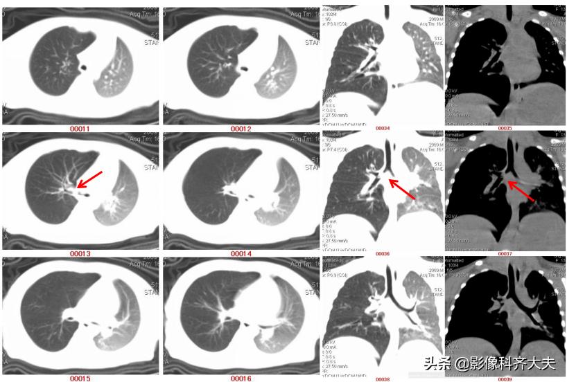 孩子支气管异物ct能查出吗,儿童支气管异物诊断方法