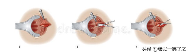 肛乳头“瘤”是不是一定要立刻手术？
