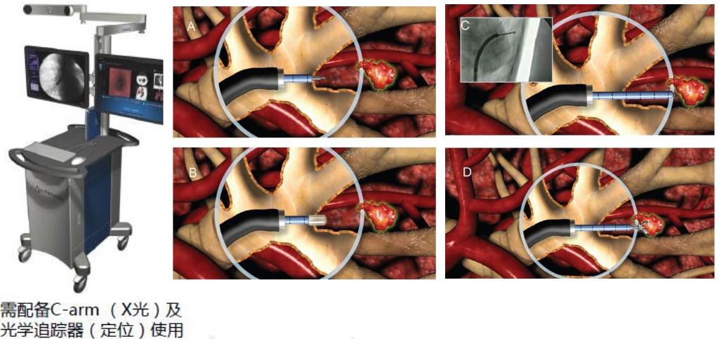 全球对肺癌治疗的最有效最新技术,肺癌的支气管镜介入治疗