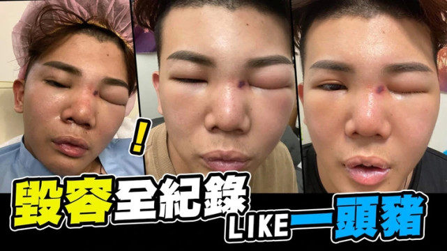 隆鼻失败网红取假体,网红整容鼻子失败案例