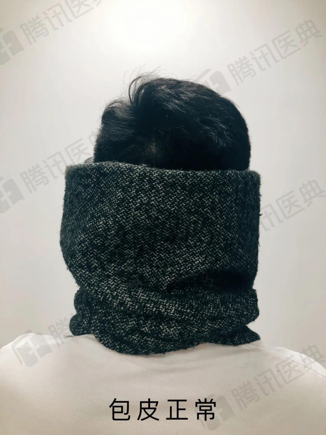 割包皮能解决系带短吗,割包皮能不能解决包皮嵌顿问题