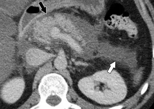简述急性胰腺炎影像学表现,有关急性胰腺炎疼痛的图片